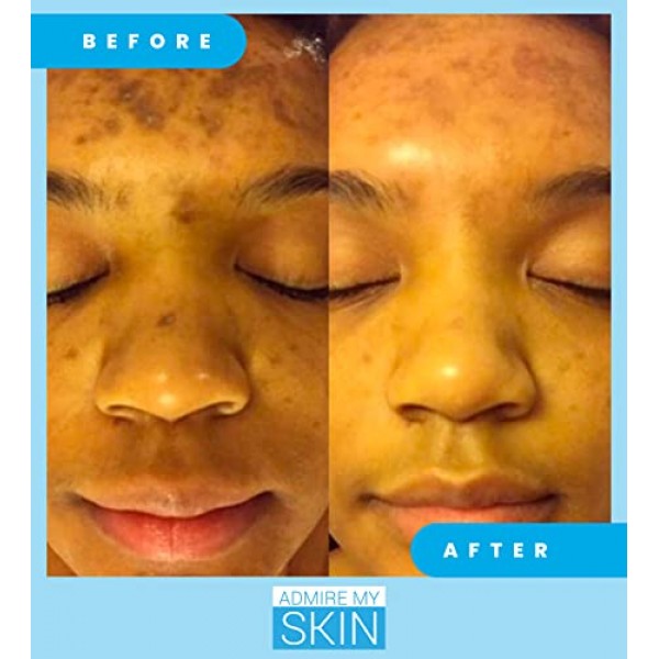 Admire My Skin Dark Spot Corrector Remover for Face - Brightening ...