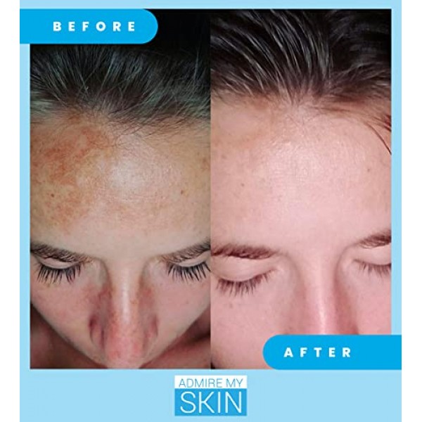 Admire My Skin Dark Spot Corrector Remover for Face - Brightening ...