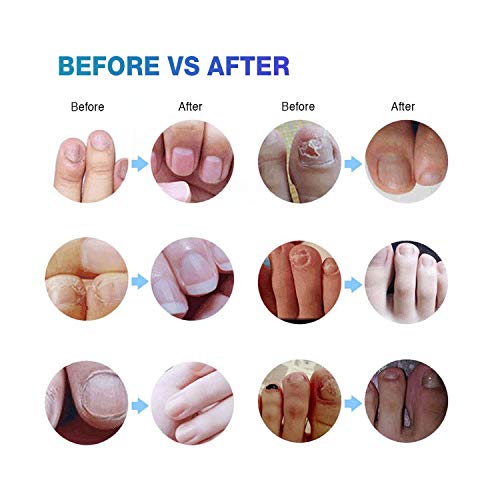 Ariella Toenail Fungus Treatment for Toenail and Fingernail, Antif...