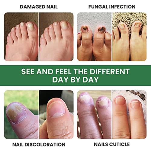 Toenail Renewal Solution Extra Strength Care for Toe Nail & Finger...