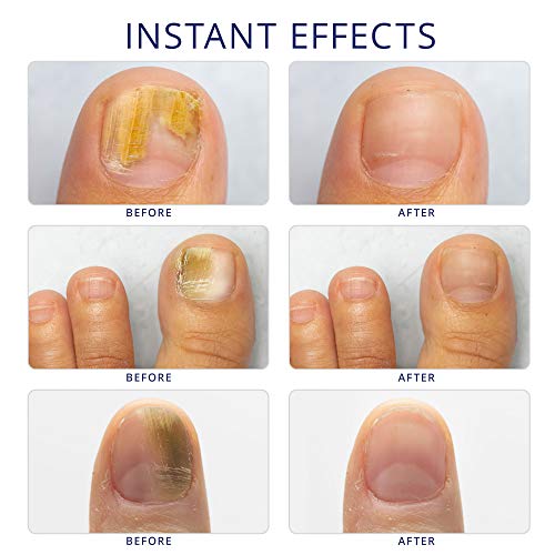 Nail Fungus Treatment for Toenail Extra Strength, Antifungal Solut...