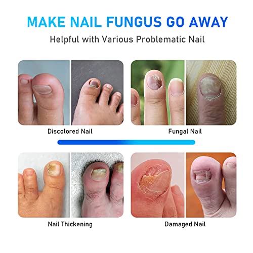 Nail Fungus Laser Treatment, Onychom Laser Cleaning Device for Fin...