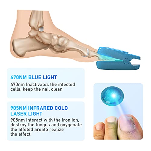 Nail Fungus Laser Treatment, Onychom Laser Cleaning Device for Fin...