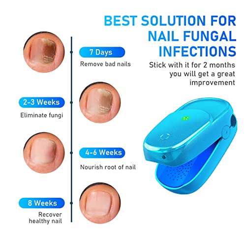 Nail Fungus Laser Treatment, Onychom Laser Cleaning Device for Fin...