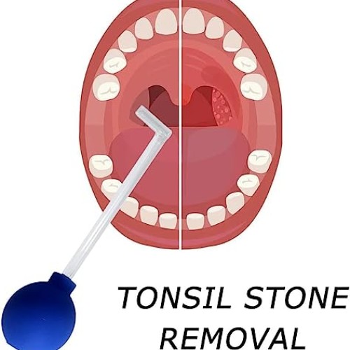KRONDO Tonsil Stone Remove Tool Manual Style Cleaner Removal Mouth...