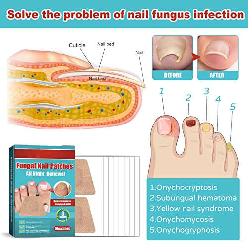 Toe Nail Patches for Fungus,Nighttime Renewal Patches,Fungal Nail ...