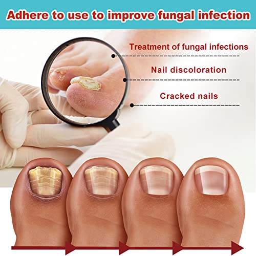 Toe Nail Patches for Fungus,Nighttime Renewal Patches,Fungal Nail ...