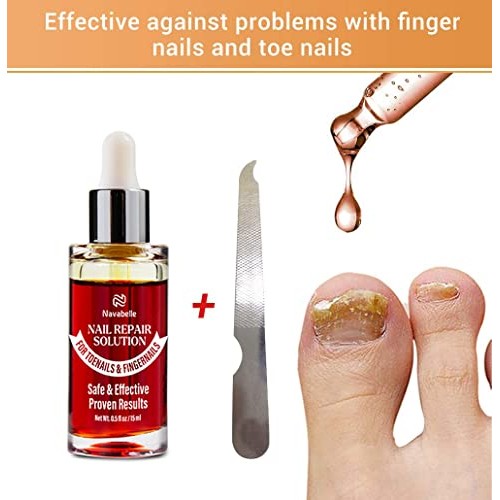 Toenail Fungus Treatment, Toe Nail Fungus Treatment for Toenail Ex...