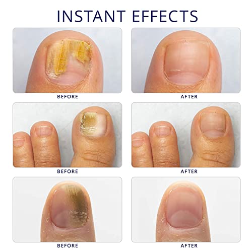 Toenail Fungus Treatment, Toe Nail Fungus Treatment for Toenail Ex...