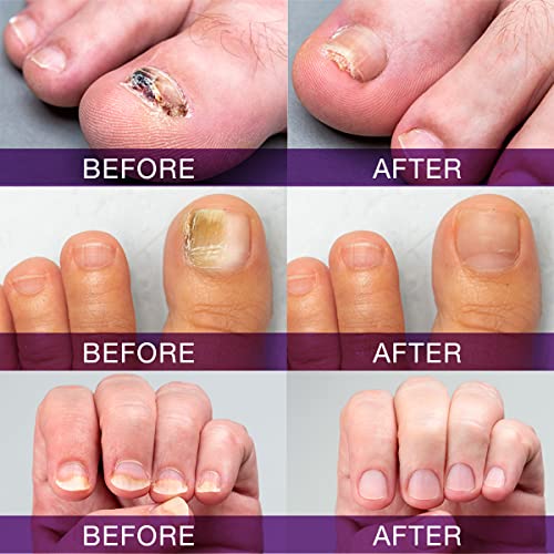Pureskin Toenail Renewal - Maximum Strength Nail Repair Liquid, To...