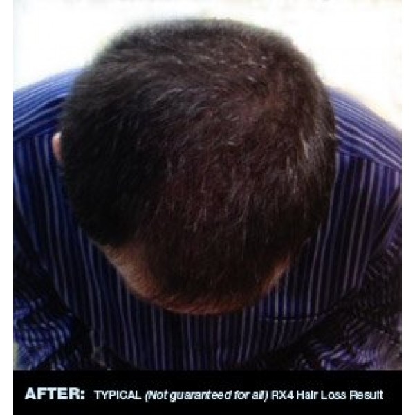 RX 4 Hair Loss Shampoo for Hair Loss Prevention in Men/Women. Natu...