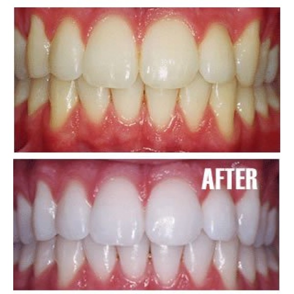 Professional Custom Dental Teeth Whitening/Bleaching Trays 1 Uppe...