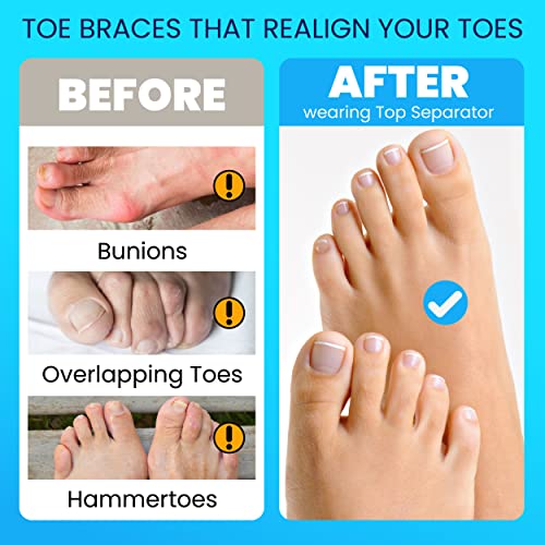 TechnoLegend Toe Separator Toe Spacers for Feet – 2 Pairs Premium ...