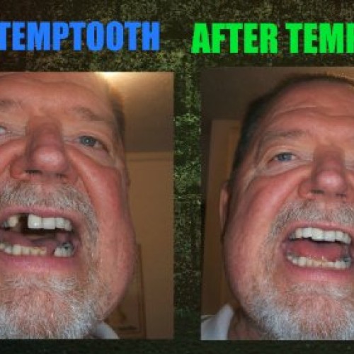 Temptooth #1 Seller Trusted Patented Temporary Tooth Replacement P...