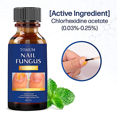 Toenail fungus treatment, Nail Fungus Treatment for Toenail, Toe N...