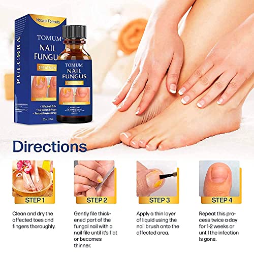 Toenail fungus treatment, Nail Fungus Treatment for Toenail, Toe N...