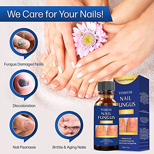 Toenail fungus treatment, Nail Fungus Treatment for Toenail, Toe N...